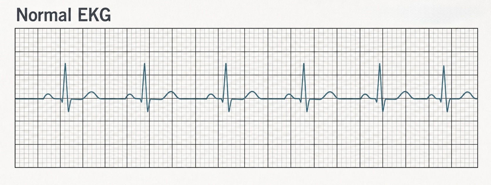 Normal EKG 教學示意圖